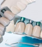 השתלות שיניים: פונקציונליות לצד קידמה טכנולוגית -תמונה